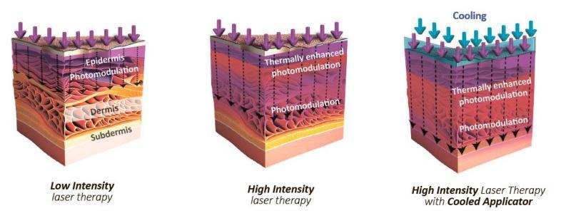 Comparison of laser therapy effectiveness